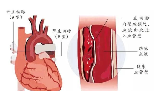 男性|台男明星猝死原因查明,九死一生的急症,青壮年男性尤其要当心