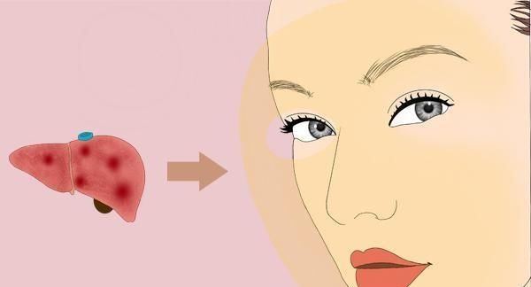  肝病|脸上长了很多黄褐斑，是肝病的前兆吗？得了肝病后