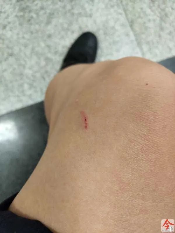 咬伤|太嚣张!柳州女子遛狗不拴绳还纵犬咬伤辅警,处理结果引起舒适