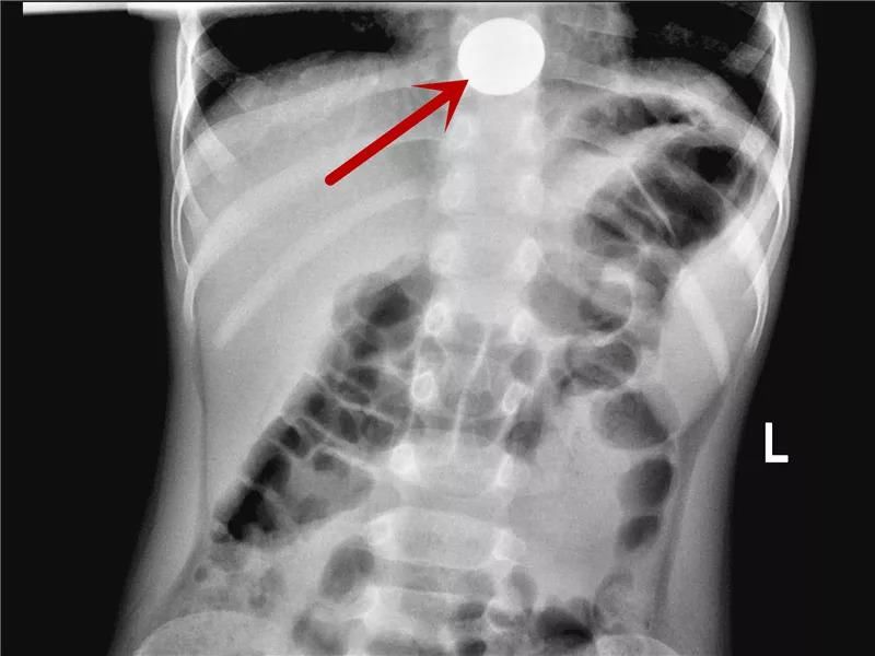  真相|有图有真相：那些年，孩子体内发现的硬币、钥匙、钉子、别针、电池……