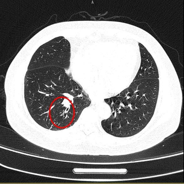  深圳|深圳女子咳嗽一年多，吃药没用！一照CT，医生懵了……