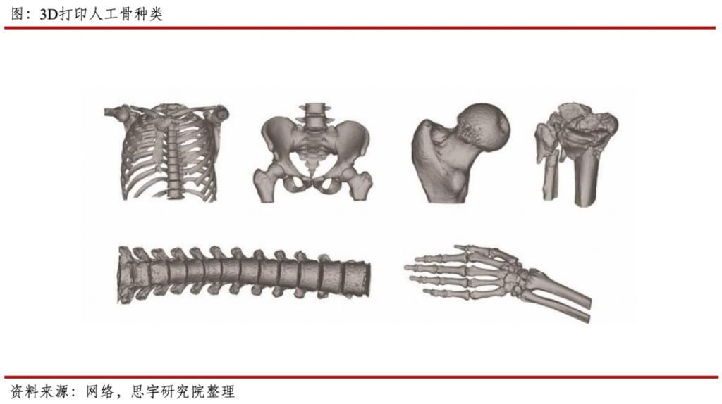 骨会|行业｜需要骨修复的患者越来越多，人工骨会是他们的救星吗？