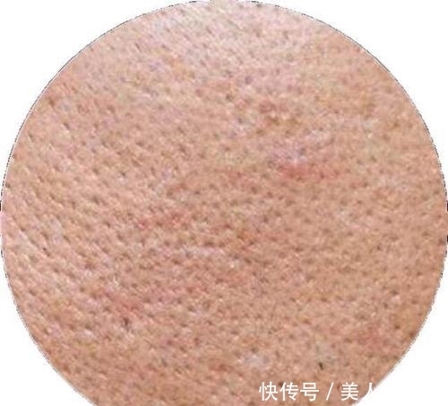 橘子|弯弯毛孔粗大宛如橘子皮,解决了6个根源,就会迎来颜值巅峰