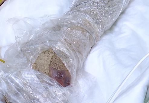  上山|命悬一线！贵州4岁男童上山采蘑菇，不幸被蛇咬伤