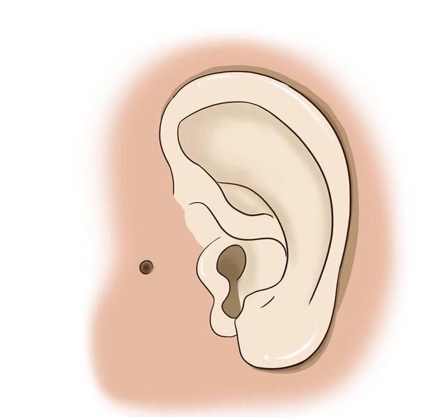  耳屎|为什么有的人耳屎是干的，有的人耳屎是湿的？原因有3点