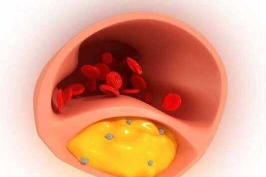 血脂|血脂反复降不下来？用中医古法调理，血脂一干二净