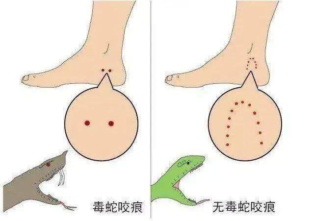 医生|父亲被毒蛇咬伤后,我想给所有人提个醒