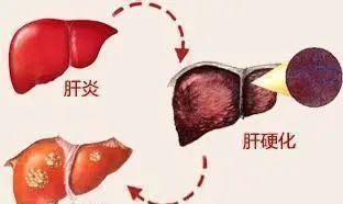 查出|夫妻先后查出肝癌，提醒：想要肝好，这种油最好一口别碰！