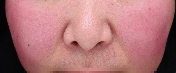  专家|脸越洗越敏感？毛孔越洗越大？皮肤专家说，那是因为你的脸洗多了