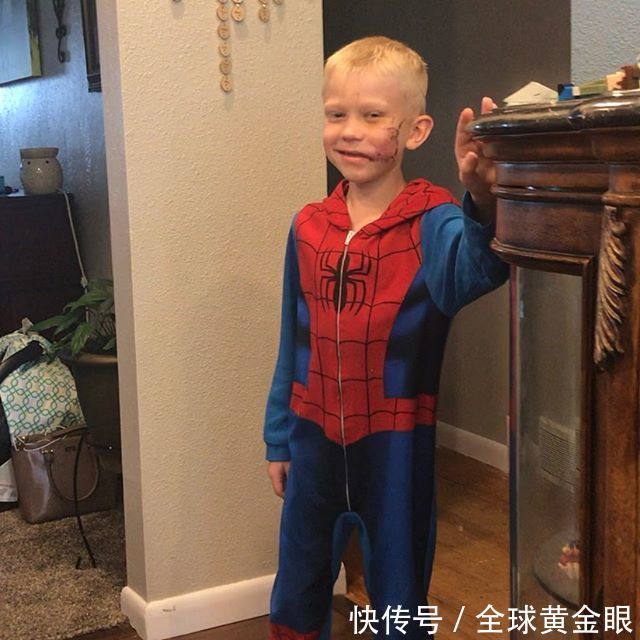  依旧|美6岁男孩为保护妹妹与恶狗搏斗，缝90针笑容依旧，获“绿巨人”盛赞