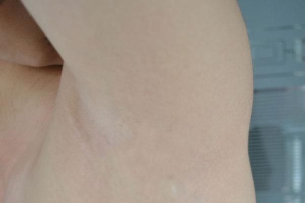  和皮肤|腋窝下长出来的小肉粒是什么？为什么会长出小肉粒，原因在哪里？