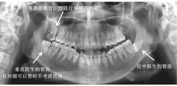  智齿|小伙子拔了颗牙 10天后脑出血离奇死亡！