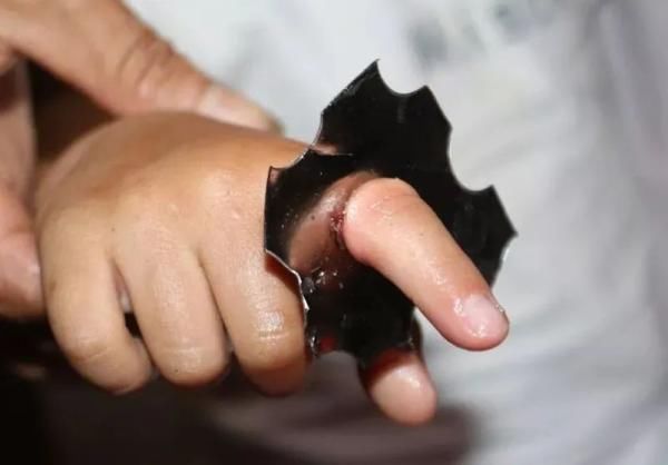  家中|浙江一幼儿手指被“吃”！这种东西家中常见，严重可截肢！