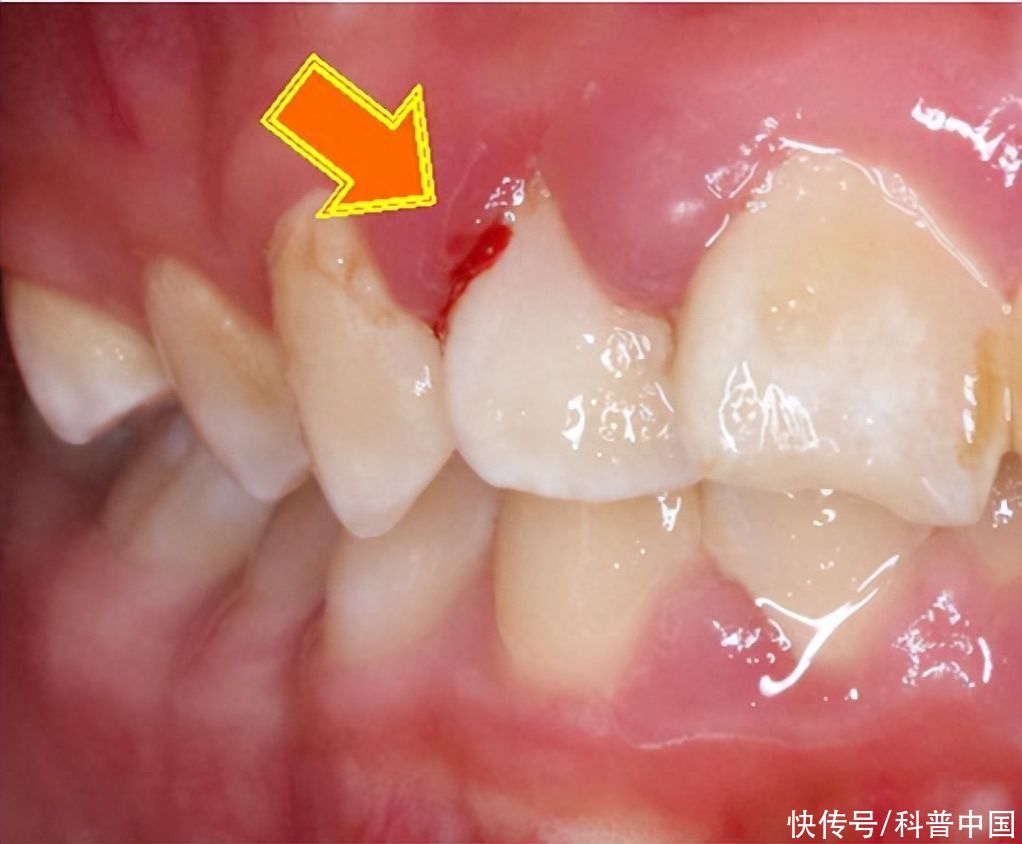 关注牙龈出血和牙齿松动，预防牙周疾病