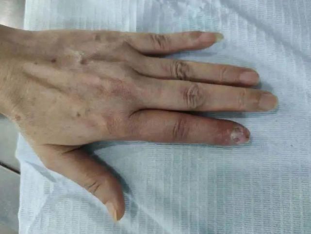  女子|爱做饭的人注意！深圳女子切菜时没留心，险些毁了一根手指