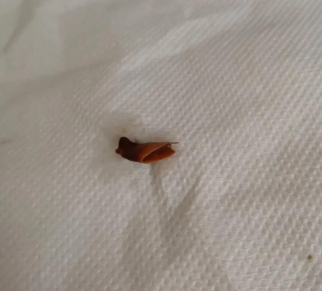  深圳|深圳女子咳嗽一年多，吃药没用！一照CT，医生懵了……