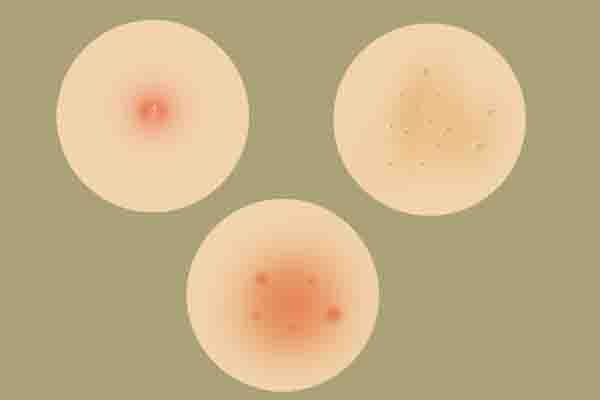  和皮肤|腋窝下长出来的小肉粒是什么？为什么会长出小肉粒，原因在哪里？