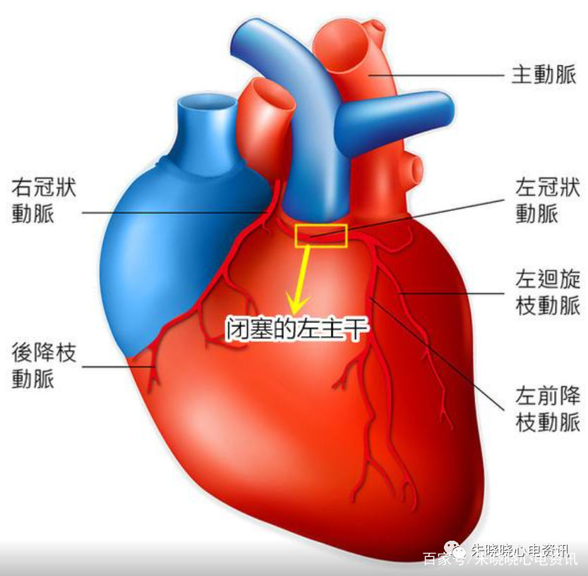 冠状动脉|左主干闭塞的心电图表现