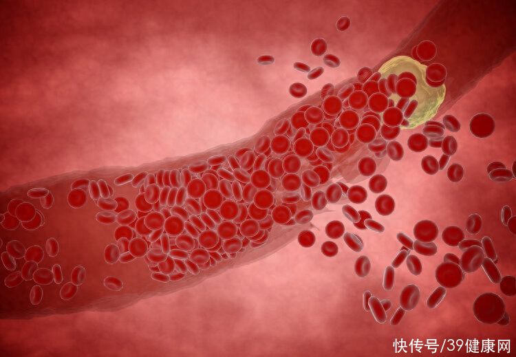 血脂胆固醇偏低容易患癌吗(上海瑞金研究发现：胆固醇越低，癌症风险越高？4个方法稳控血脂)