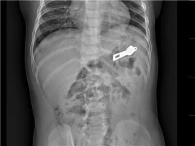  真相|有图有真相：那些年，孩子体内发现的硬币、钥匙、钉子、别针、电池……