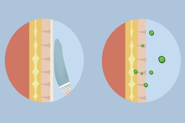  和皮肤|腋窝下长出来的小肉粒是什么？为什么会长出小肉粒，原因在哪里？