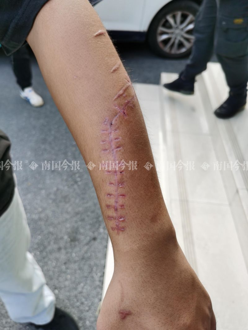 砍伤|柳州外卖小哥凌晨追贼被砍伤，案发8天后歹徒落网