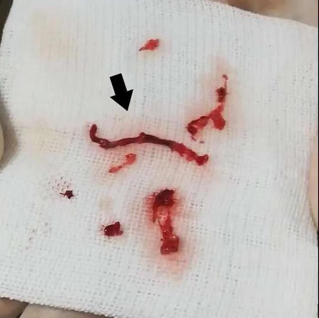  半身不遂|31岁年轻妈妈突发半身不遂 医生还原可怕的家庭真相