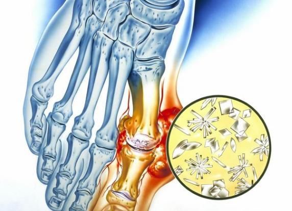  女性|45岁以上要警惕高尿酸痛风来袭，这5类饮食，尽量不要端上桌