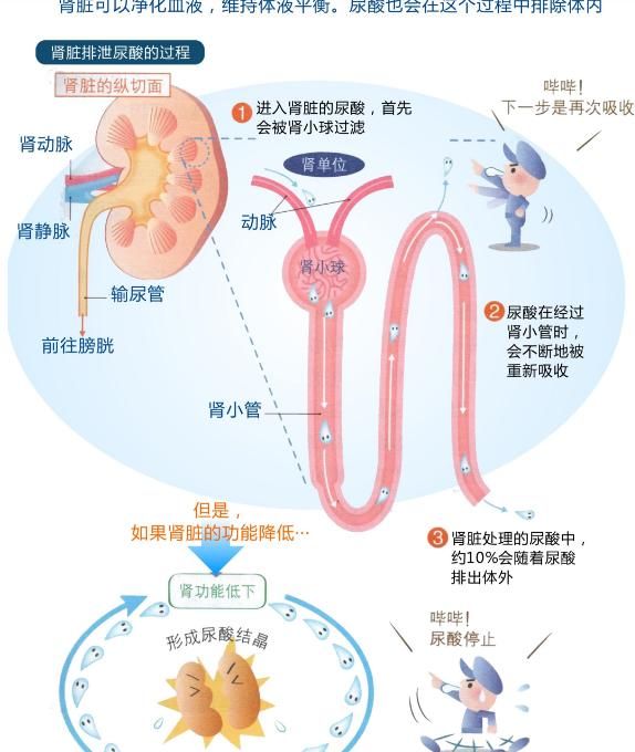 肾病|痛风引起的肾脏不好有什么症状？尿酸性肾病如何降尿酸保肾？