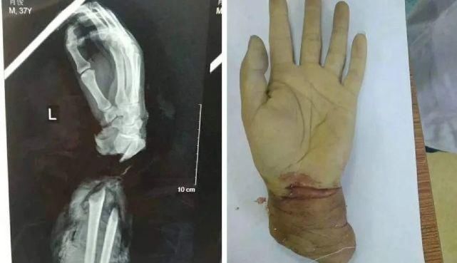 锯断|是个狠人！22岁女子为骗800万保险金，锯断了自己的手