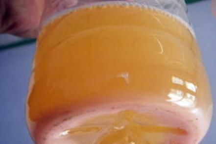  此前|男子患尿毒症，靠透析维持生命，此前身体早有提示，只是他忽视了