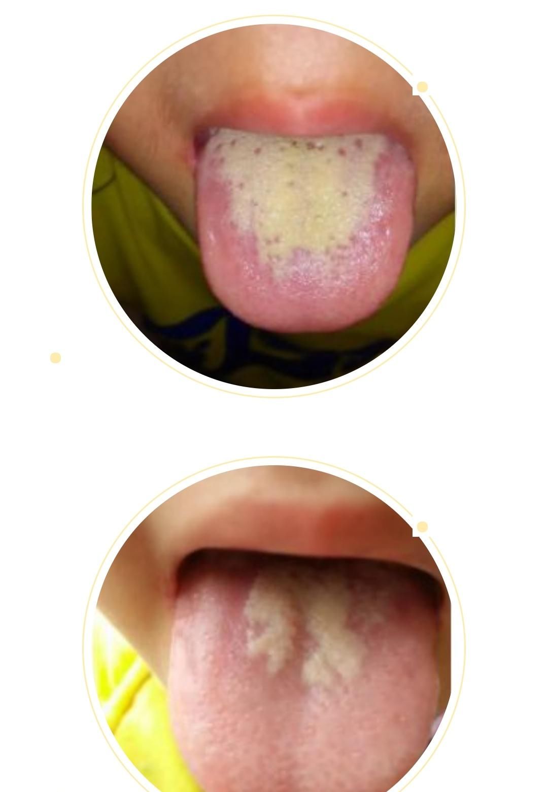  变化|身体健康情况怎么样？可以从舌头进行窥探