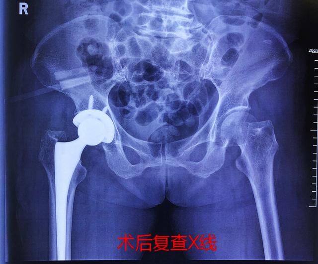  股骨颈骨折|七旬老人摔跤后未在意被送医，专家提醒警惕“隐匿性”骨折