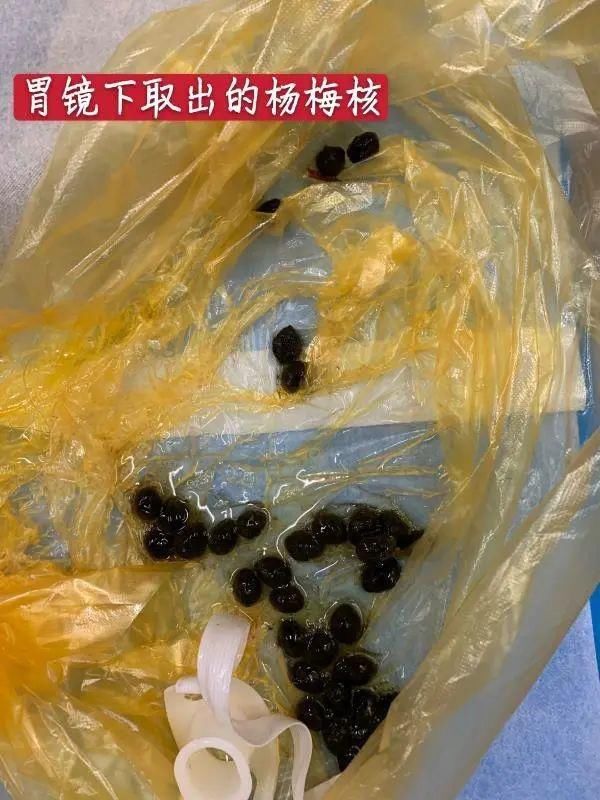  东西|吞下这些东西后，5旬男子腹痛难忍！肚子里竟取出了…