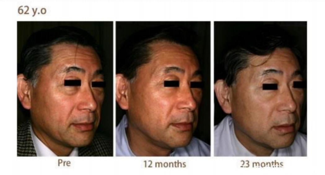 治疗|日本最先端保养品,干细胞上清液!