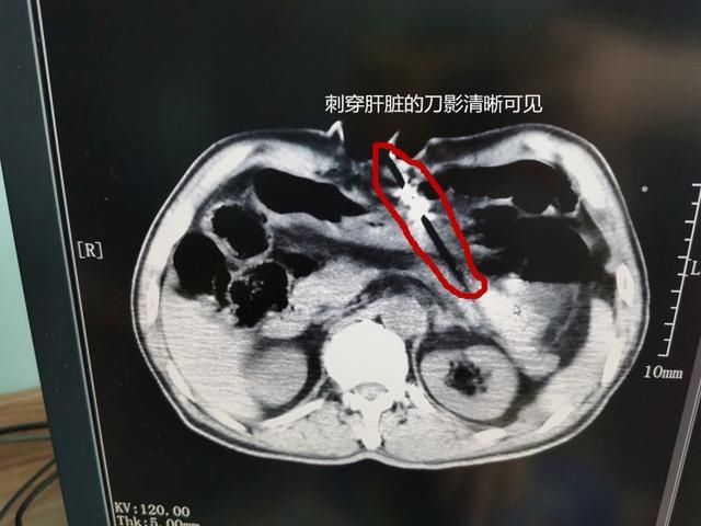  小时|割腕割喉自杀4小时没死后悔 青岛一男子给妻子打电话求救