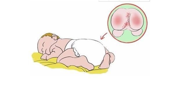  宝宝|宝宝红屁股怎么样好得快？你或许真的不知道，看看育儿专家的理解