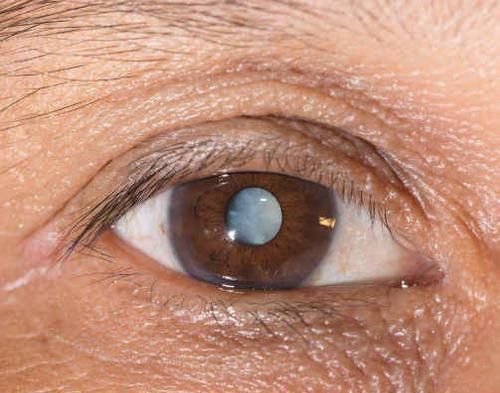 循环系统|白内障术后病情反复？医师说：术后补几种营养素可防复发