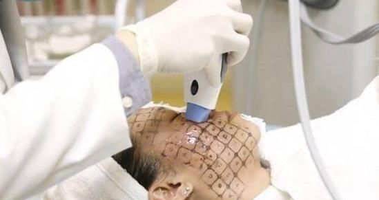  医生|皮肤科医生科普热玛吉——操作过程及患者问答，看完就不懵了