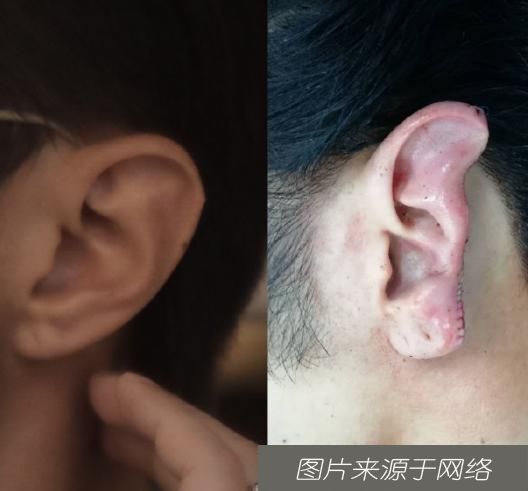 耳朵|男子见义勇为阻止性侵被咬掉半只耳，需做开颅手术，事后坚称“不后悔！”