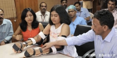  截肢|印度女孩双手截肢后，移植黑人男子手臂，两年后全身皮肤开始变黑