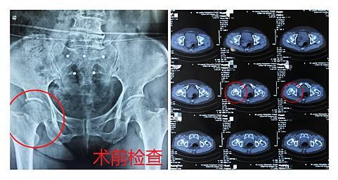  股骨颈骨折|七旬老人摔跤后未在意被送医，专家提醒警惕“隐匿性”骨折