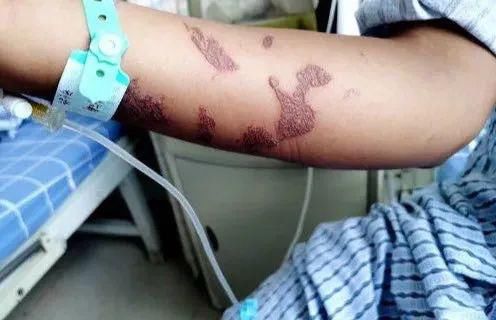  漳浦|注意！漳浦已经有人到海边游泳遇到这种东西，被蛰进医院了！