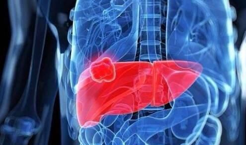  答案|体检查出了小结节、息肉，会发生癌变吗，医生给你正确答案