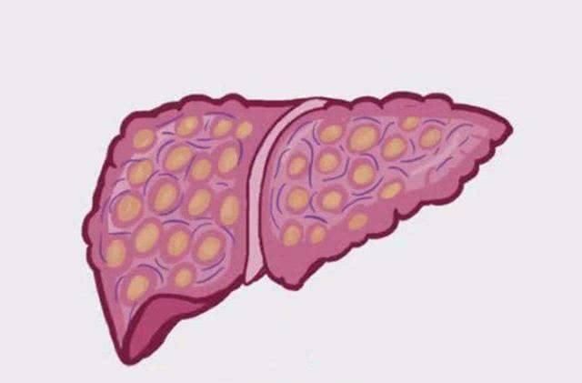  表现|肝癌是酒“泡”出来的？提醒：早起有4个表现，快戒酒，查查肝