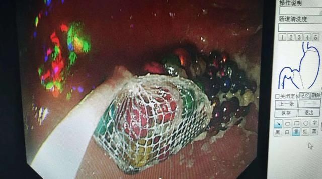  留置|济南一5岁女孩，误吞190颗巴克球，胃内留置俩月，胃镜全部取出后，医生惊呼奇迹……