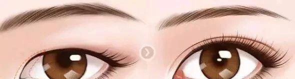  近视眼矫正|想做双眼皮，又想做近视眼手术，该怎么安排？