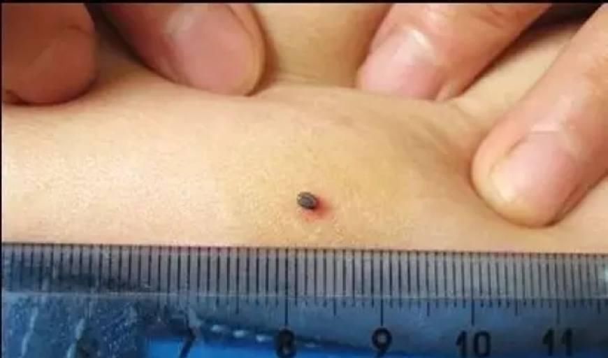  虫子|重要: 被咬一口致命, 这虫子随处可见, 干农活千万要注意