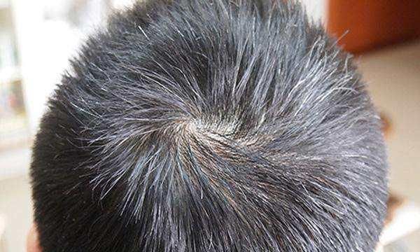  用于|张景岳：留下三味药，巧用于“少白头”，让肾脏显年轻