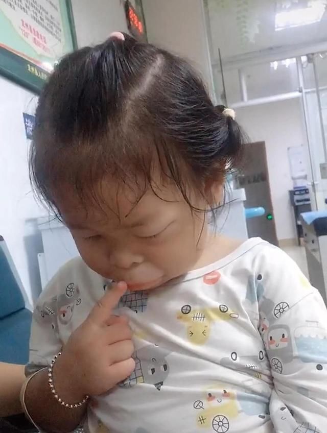 嘴巴|女儿吃芒果过敏,嘴巴2小时就肿成了“鸭子嘴”,亲妈笑出鹅叫声